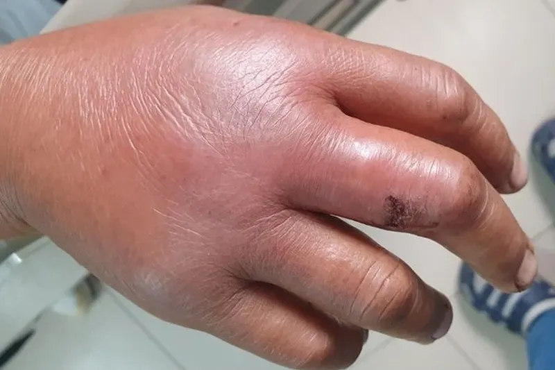 Thư viện hình ảnh Viêm mô tế bào, cập nhật mới nhất 26