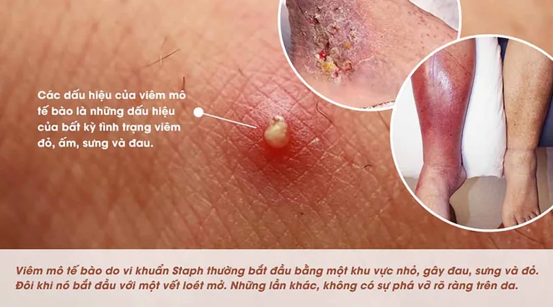 Thư viện hình ảnh Viêm mô tế bào, cập nhật mới nhất 5