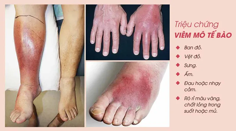 Thư viện hình ảnh Viêm mô tế bào, cập nhật mới nhất 6