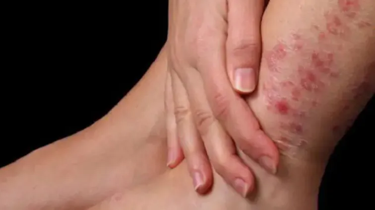 Thư viện hình ảnh Viêm mô tế bào, cập nhật mới nhất 8