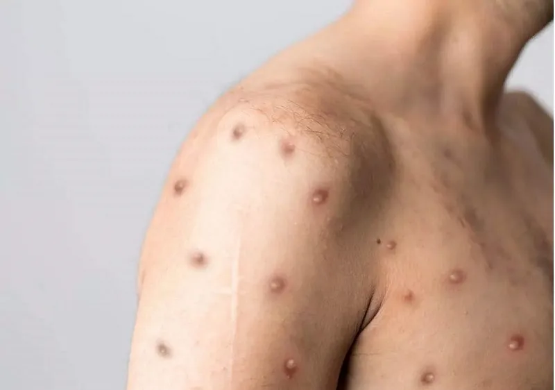 Tổng hợp hình ảnh thủy đậu từ A đến Z về căn bệnh này 11