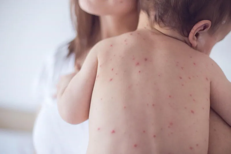 Tổng hợp hình ảnh thủy đậu từ A đến Z về căn bệnh này 15
