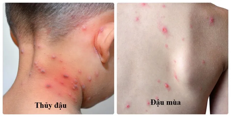 Tổng hợp hình ảnh thủy đậu từ A đến Z về căn bệnh này 16