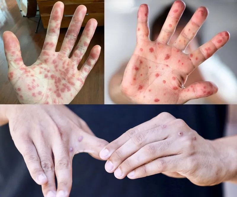 Tổng hợp hình ảnh thủy đậu từ A đến Z về căn bệnh này 17