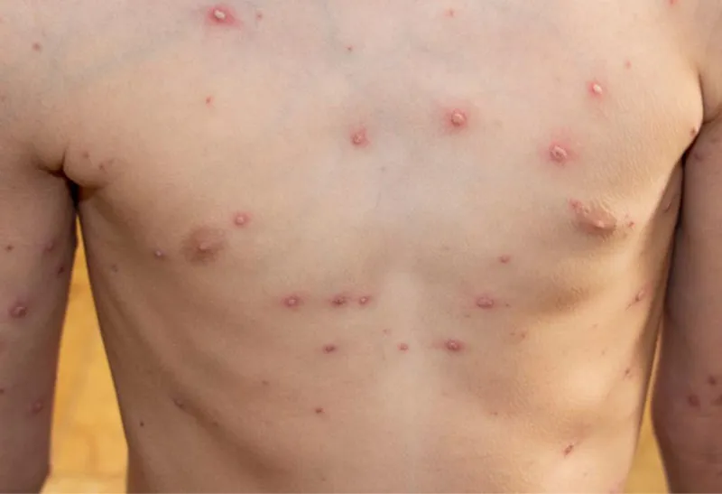 Tổng hợp hình ảnh thủy đậu từ A đến Z về căn bệnh này 18