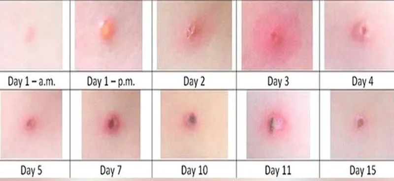 Tổng hợp hình ảnh thủy đậu từ A đến Z về căn bệnh này 21