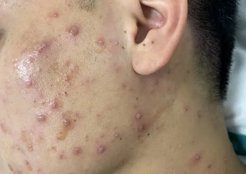 Tổng hợp hình ảnh thủy đậu từ A đến Z về căn bệnh này 4