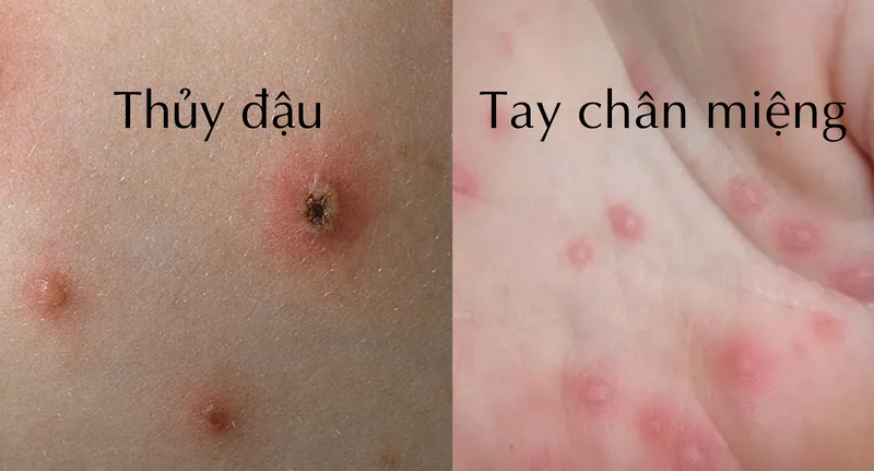 Tổng hợp hình ảnh thủy đậu từ A đến Z về căn bệnh này 19