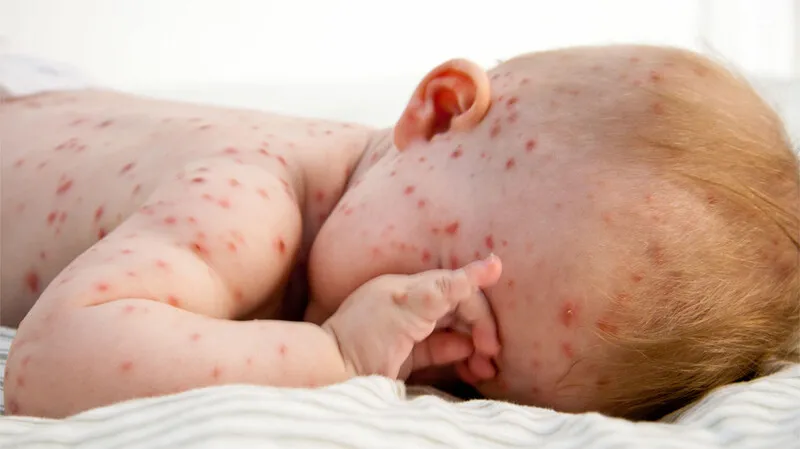 Tổng hợp hình ảnh thủy đậu từ A đến Z về căn bệnh này 20