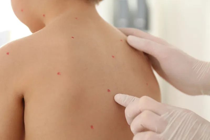 Tổng hợp hình ảnh thủy đậu từ A đến Z về căn bệnh này 24