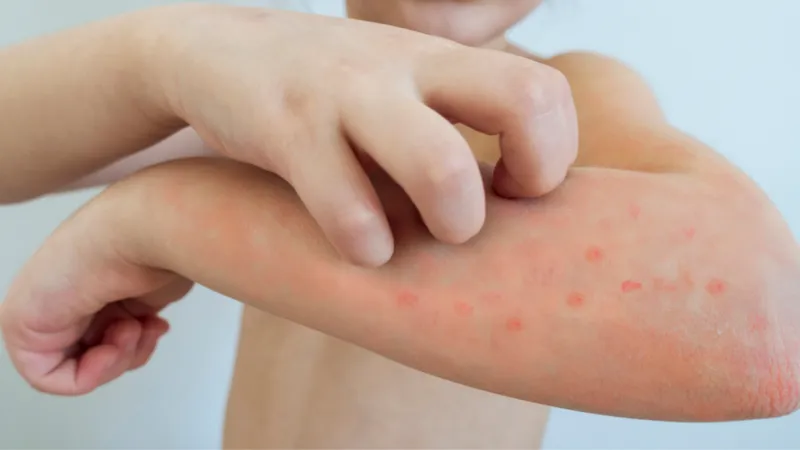 Tổng hợp hình ảnh thủy đậu từ A đến Z về căn bệnh này 25