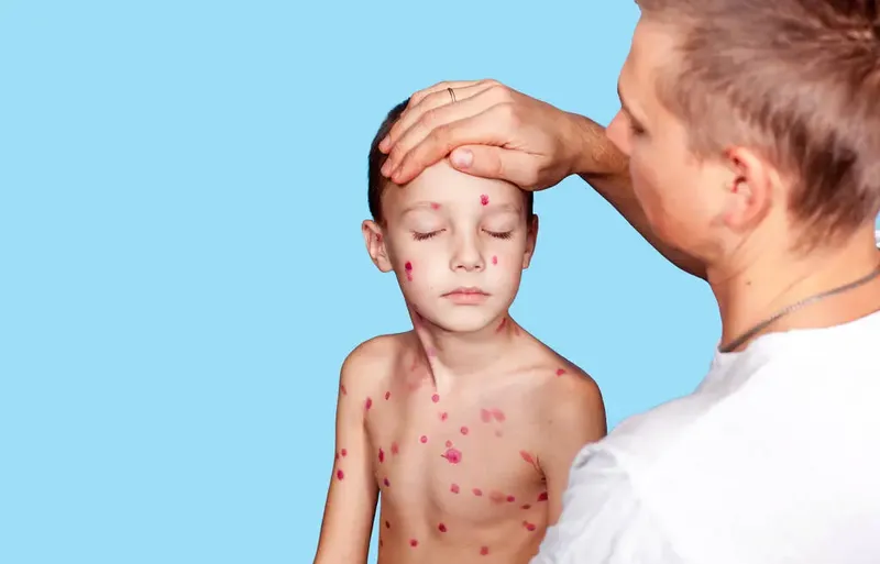 Tổng hợp hình ảnh thủy đậu từ A đến Z về căn bệnh này 26