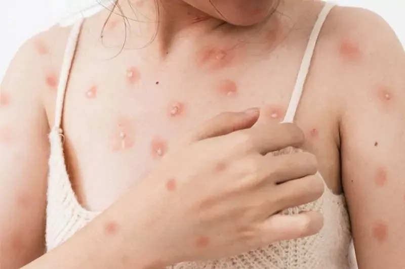 Tổng hợp hình ảnh thủy đậu từ A đến Z về căn bệnh này 28