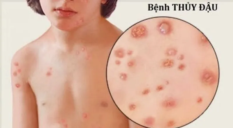Tổng hợp hình ảnh thủy đậu từ A đến Z về căn bệnh này 5