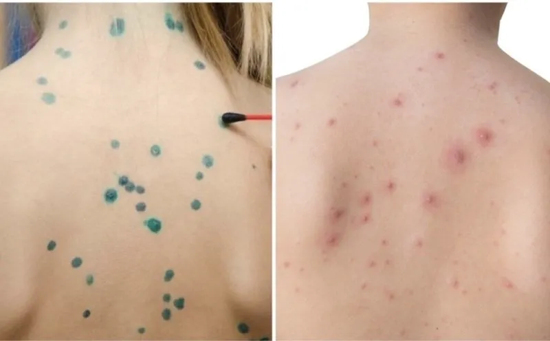 Tổng hợp hình ảnh thủy đậu từ A đến Z về căn bệnh này 29