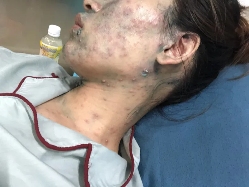 Tổng hợp hình ảnh thủy đậu từ A đến Z về căn bệnh này 30