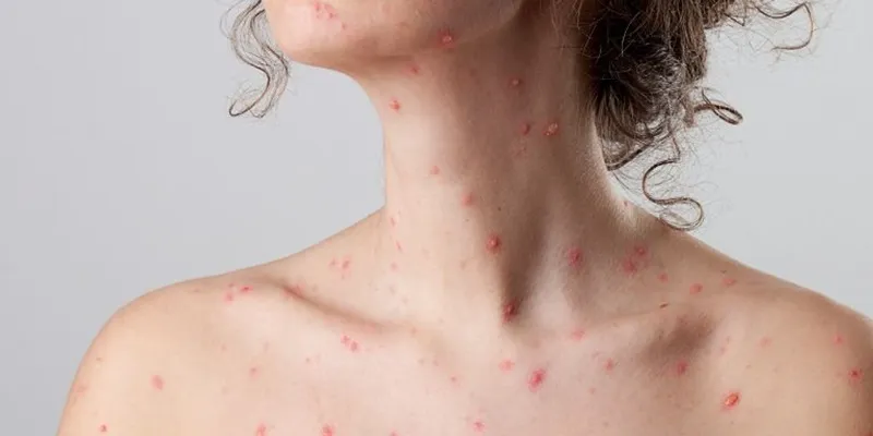 Tổng hợp hình ảnh thủy đậu từ A đến Z về căn bệnh này 33