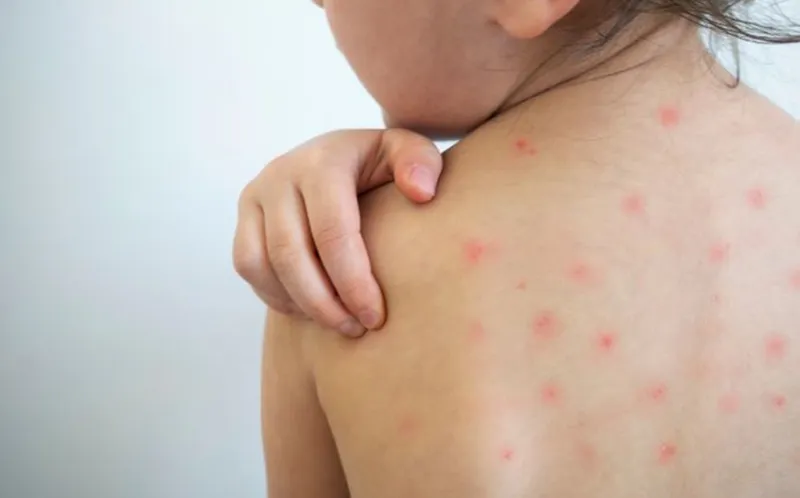 Tổng hợp hình ảnh thủy đậu từ A đến Z về căn bệnh này 6