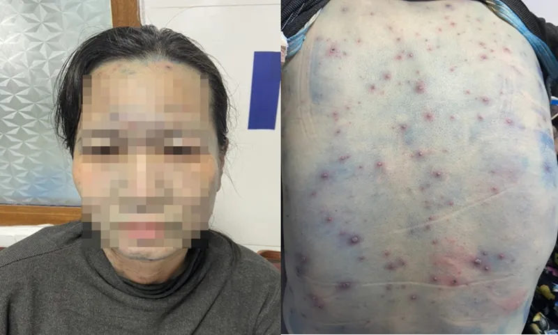 Tổng hợp hình ảnh thủy đậu từ A đến Z về căn bệnh này 7