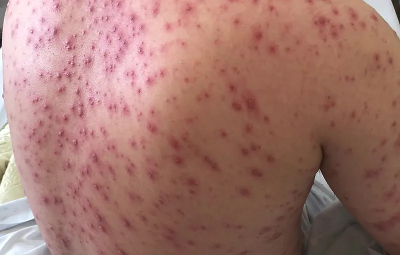Tổng hợp hình ảnh thủy đậu từ A đến Z về căn bệnh này 8