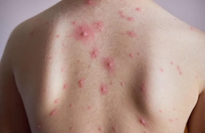 Tổng hợp hình ảnh thủy đậu từ A đến Z về căn bệnh này 9