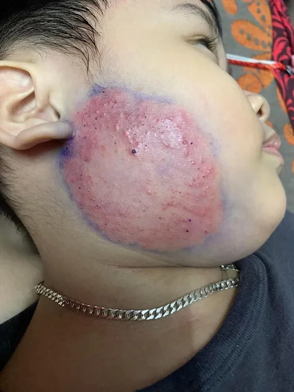 Tổng hợp hình ảnh viêm da tiếp xúc, từ A đến Z 1