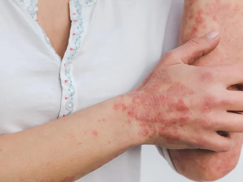 Tổng hợp hình ảnh viêm da tiếp xúc, từ A đến Z 12