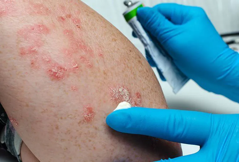 Tổng hợp hình ảnh viêm da tiếp xúc, từ A đến Z 16