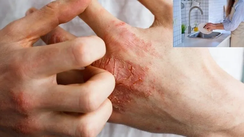 Tổng hợp hình ảnh viêm da tiếp xúc, từ A đến Z 18