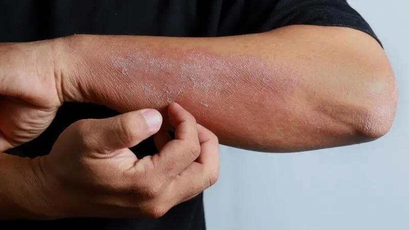 Tổng hợp hình ảnh viêm da tiếp xúc, từ A đến Z 19