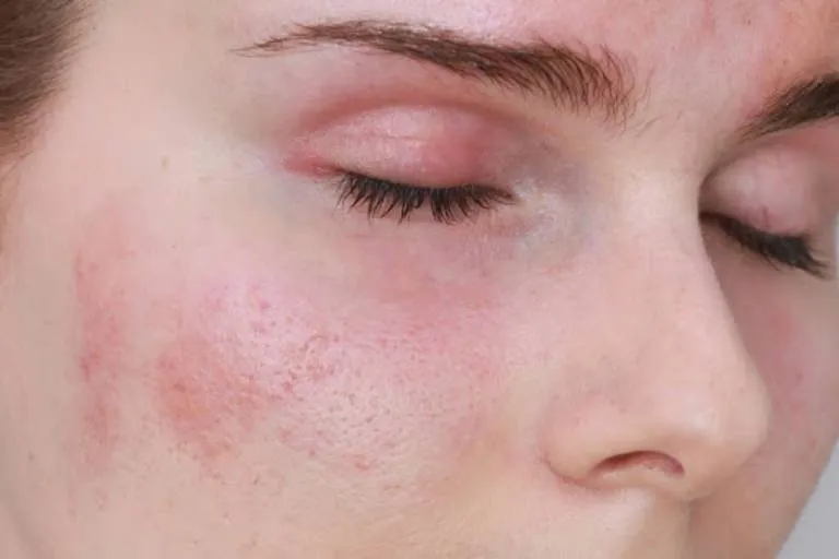 Tổng hợp hình ảnh viêm da tiếp xúc, từ A đến Z 24