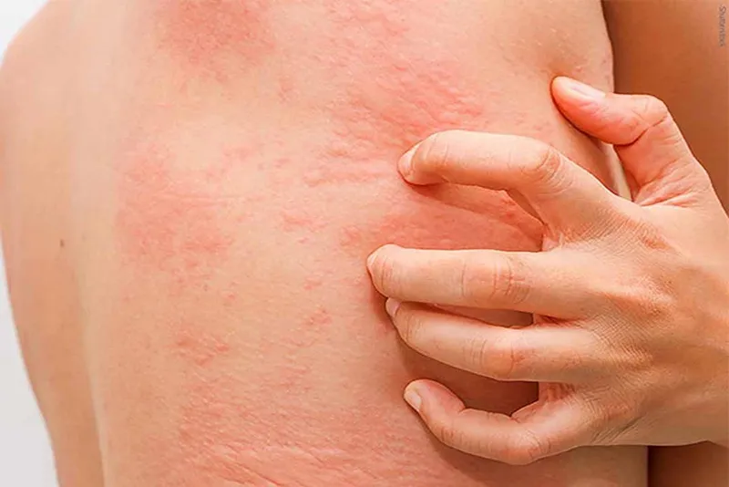 Tổng hợp hình ảnh viêm da tiếp xúc, từ A đến Z 4