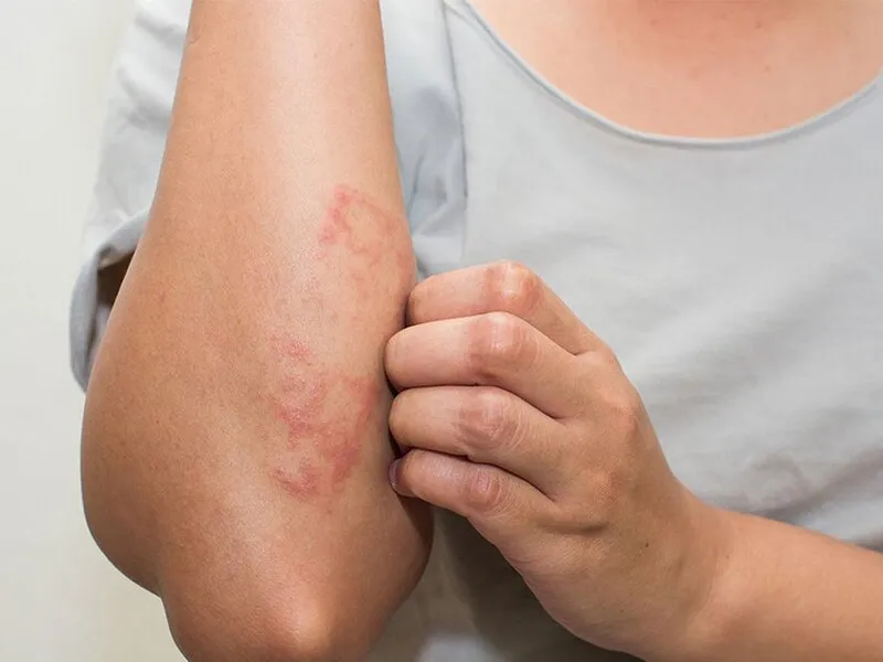 Tổng hợp hình ảnh viêm da tiếp xúc, từ A đến Z 5