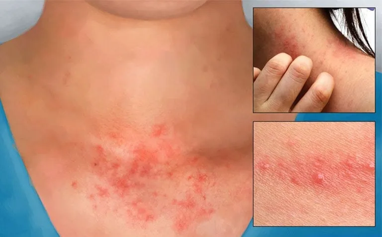 Tổng hợp hình ảnh viêm da tiếp xúc, từ A đến Z 9