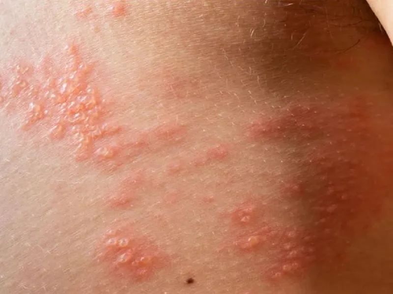 Zona thần kinh, phòng ngừa và điều trị qua hình ảnh 15
