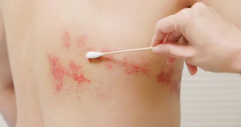 Zona thần kinh, phòng ngừa và điều trị qua hình ảnh 28