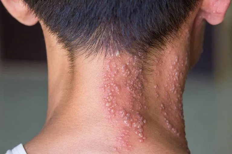Zona thần kinh, phòng ngừa và điều trị qua hình ảnh 29
