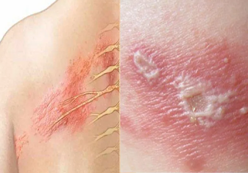 Zona thần kinh, phòng ngừa và điều trị qua hình ảnh 31