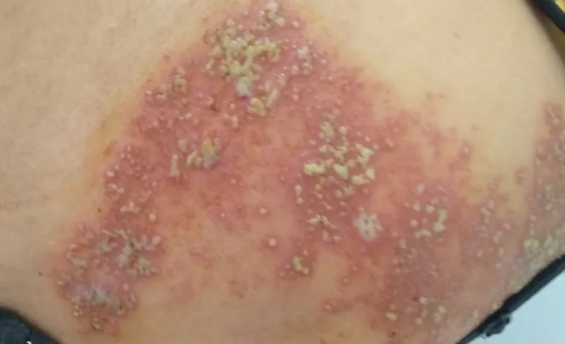 Zona thần kinh, phòng ngừa và điều trị qua hình ảnh 34