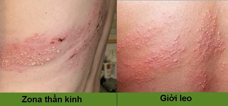 Zona thần kinh, phòng ngừa và điều trị qua hình ảnh 35