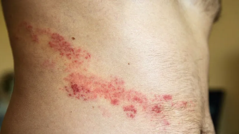 Zona thần kinh, phòng ngừa và điều trị qua hình ảnh 3