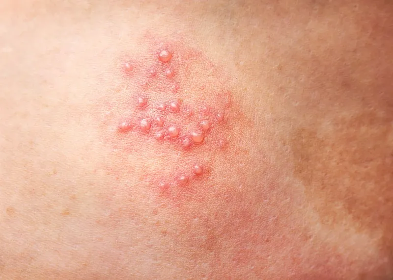 Zona thần kinh, phòng ngừa và điều trị qua hình ảnh 4