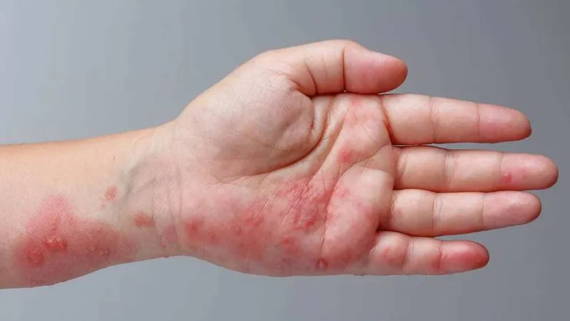 Zona thần kinh, phòng ngừa và điều trị qua hình ảnh 5