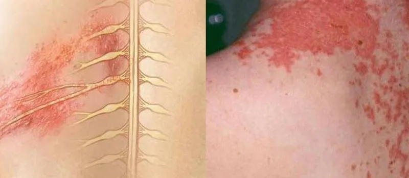 Zona thần kinh, phòng ngừa và điều trị qua hình ảnh 6