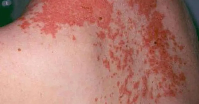 Zona thần kinh, phòng ngừa và điều trị qua hình ảnh 9