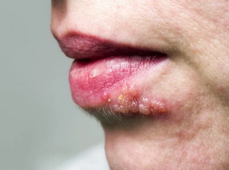 Zona thần kinh, phòng ngừa và điều trị qua hình ảnh 18
