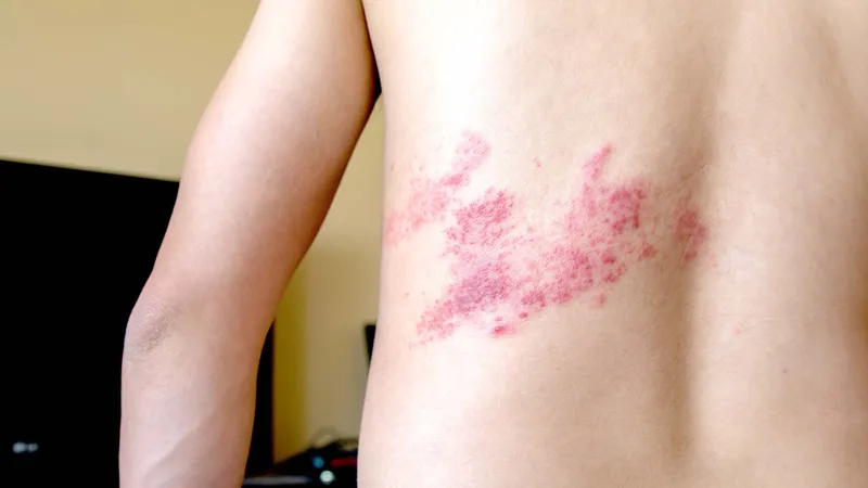 Zona thần kinh, phòng ngừa và điều trị qua hình ảnh 10