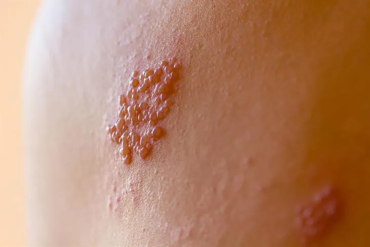 Zona thần kinh, phòng ngừa và điều trị qua hình ảnh 12