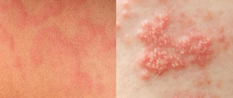 Zona thần kinh, phòng ngừa và điều trị qua hình ảnh 13