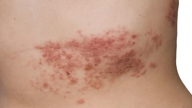 Zona thần kinh, phòng ngừa và điều trị qua hình ảnh 14